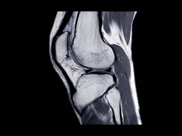 MRI Knee joint or Magnetic resonance imaging  sagittal view for detect tear or sprain of the anterior cruciate  ligament (ACL). stock photo