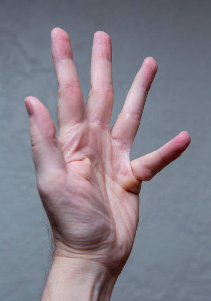 istock Dupuytren's contracture 1197758265