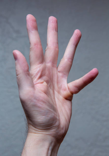 Dupuytren's contracture stock photo