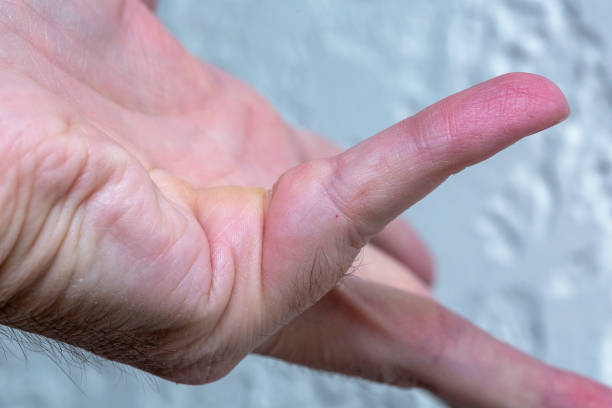 Dupuytren's contracture stock photo