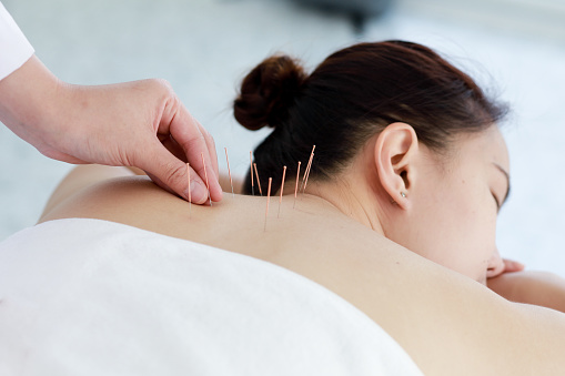 hand of doctor performing acupuncture therapy . Asian female undergoing acupuncture treatment with a line of fine needles inserted into the her body skin in clinic hospital