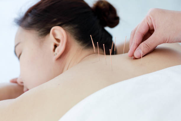 istock hand of doctor performing acupuncture therapy 1197783085