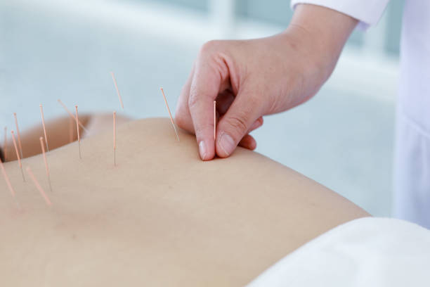 istock hand of doctor performing acupuncture therapy 1197783102