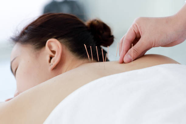 istock hand of doctor performing acupuncture therapy 1197783115