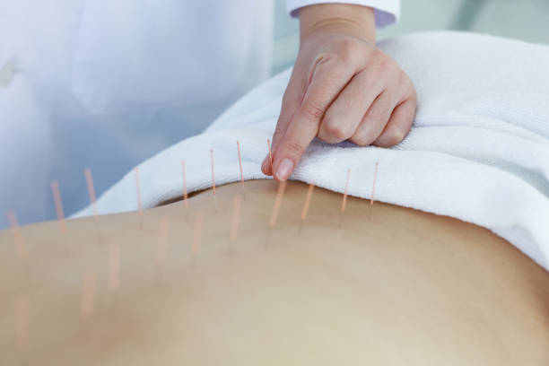 istock hand of doctor performing acupuncture therapy 1197783122