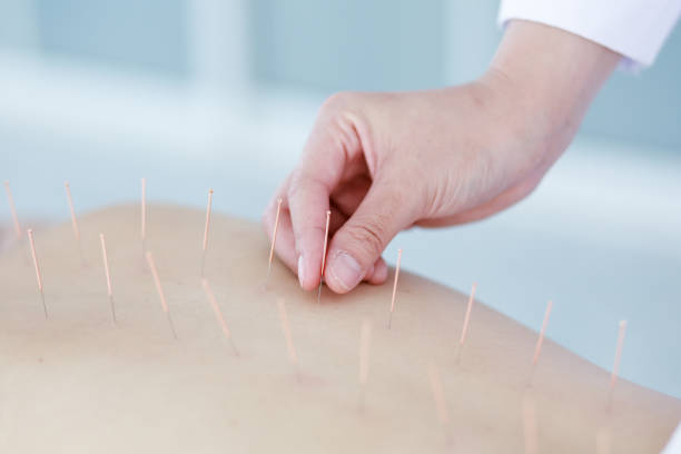 istock hand of doctor performing acupuncture therapy 1197783152