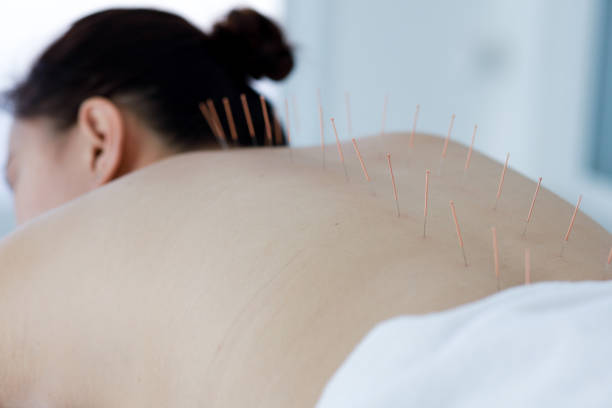 istock hand of doctor performing acupuncture therapy 1197783165