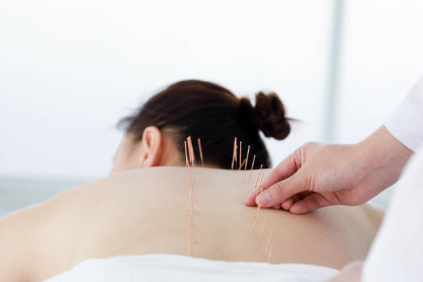 istock hand of doctor performing acupuncture therapy 1197783166