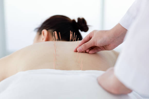 istock hand of doctor performing acupuncture therapy 1197783167