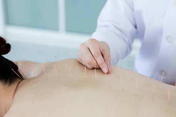 istock hand of doctor performing acupuncture therapy 1197783209