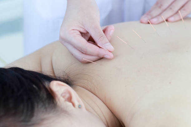 istock hand of doctor performing acupuncture therapy 1197783243