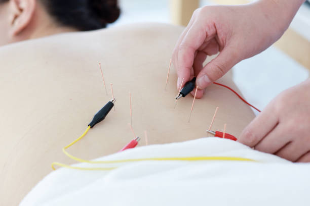 istock hand of doctor performing acupuncture therapy 1197783264