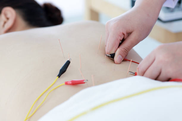 istock hand of doctor performing acupuncture therapy 1197783295