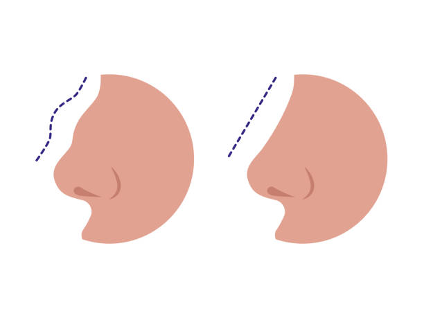 illustrazioni stock, clip art, cartoni animati e icone di tendenza di naso prima e dopo la correzione della rinoplastica - nose job illustrations