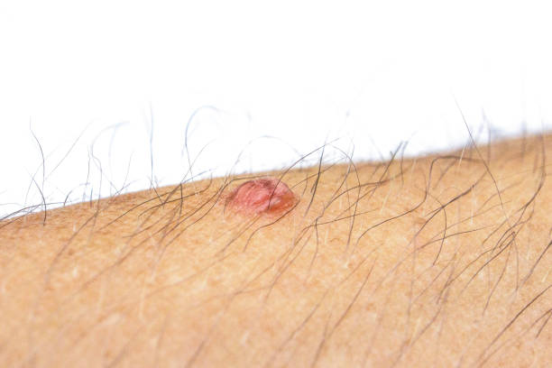 istock close-up wart on a hairy human body, front and background blurred with bokeh effect 1197819988