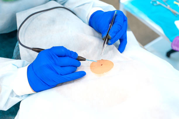 nahaufnahme chirurg verbrennt einen maulwurf auf dem rücken des patienten. maulwurfentfernung chirurgie verfahren - biopsie stock-fotos und bilder