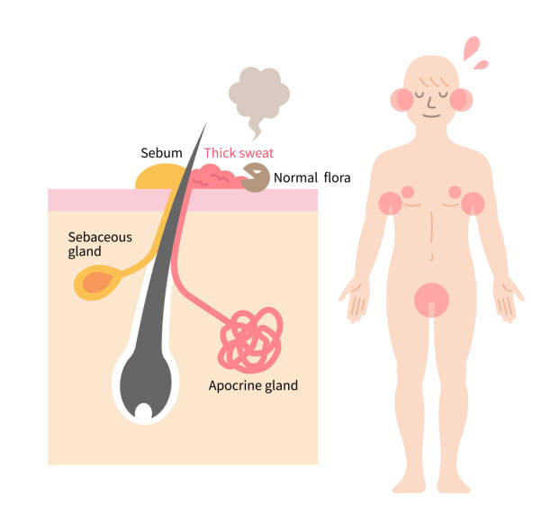 sweat from apocrine glands is associated with body odor. Health care concept Body odor is caused by bacteria breaking down sweat from apocrine glands. skin layer and man body illustration. Isolated on white background sweat gland stock illustrations