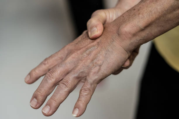 istock Tendinitis Overuse hand problems. Old man hand with red spot o fingers as suffer from Carpal tunnel syndrome. The symptoms of tingling, numbness, weakness, or pain of the fingers and wrist. 1198035061