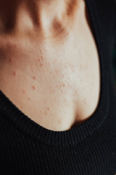 istock Allergy on woman's chest 1198071358