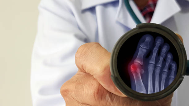 Orthopedic doctor exam and show film X-ray foot radiograph of Hallux valgus deformity or Bunion disease. The patient has toe pain problem. Medical diagnosis and treatment technology concept Toe bone has Hallux valgus deformity or Bunion disease spinal surgery recovery stock pictures, royalty-free photos & images