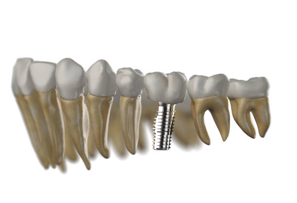 implant dentystyczny na dolnych zębach renderowania 3d - 2574 zdjęcia i obrazy z banku zdjęć