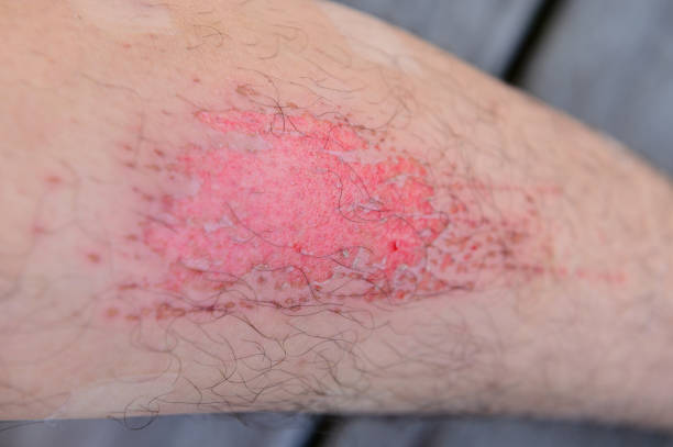 istock Closeup human legs with fresh wound 1198371002
