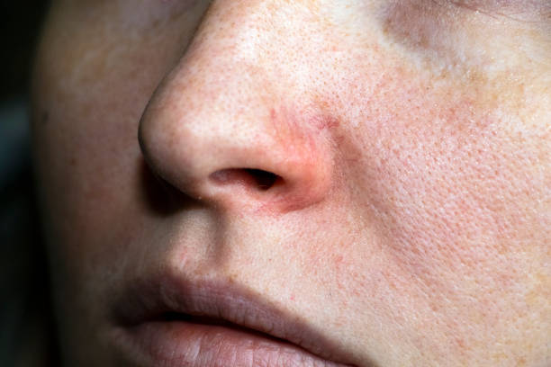 cuperosi sul naso di una giovane donna. acne sul viso. esame da parte di un medico - naso rosso foto e immagini stock