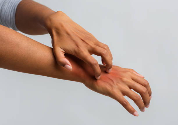 istock Woman scratching her hand, suffering from psoriasis 1198636776