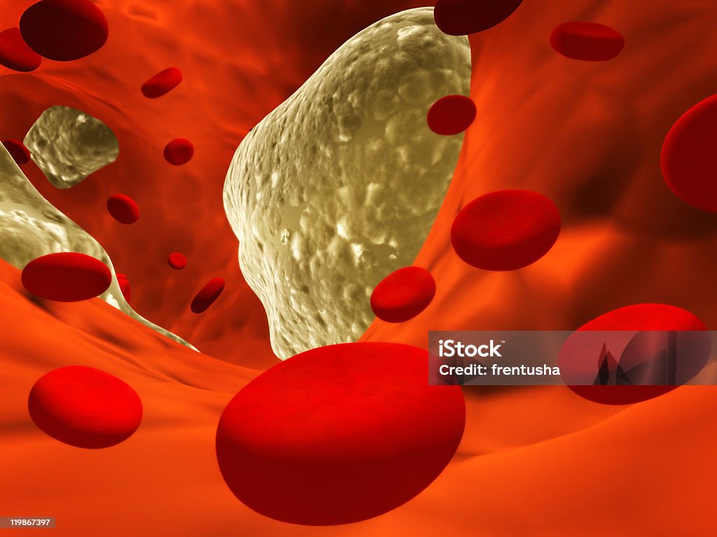 Atherosclerosis  Biomedical Illustration Stock Photo