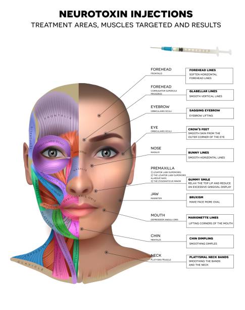 ilustraciones, imágenes clip art, dibujos animados e iconos de stock de inyecciones de neurotoxinas - botox