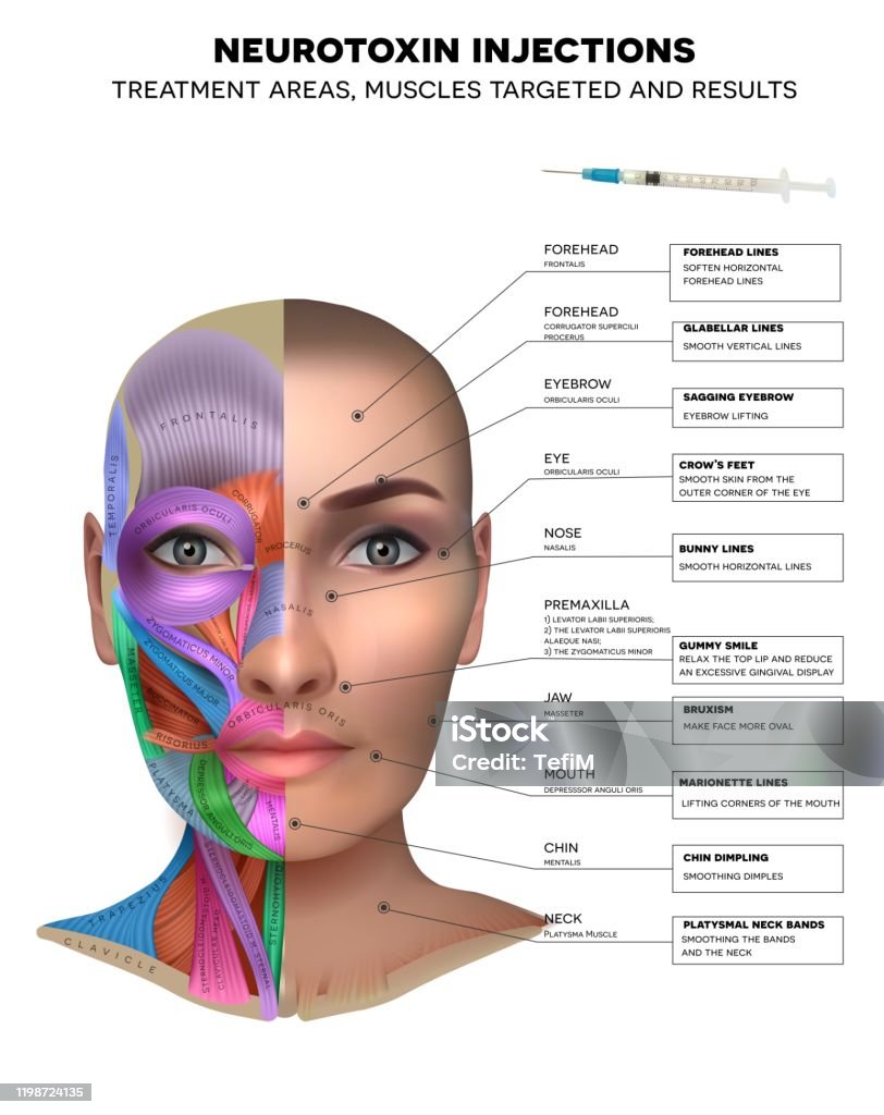 Neurotoxin injections Neurotoxin injections treatment areas, muscles targeted and results. Muscles structure of the female face and neck, each muscle with name on it. Botulinum Toxin Injection stock vector