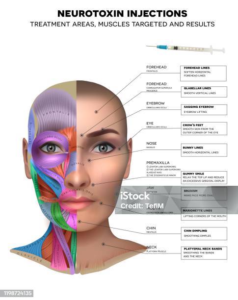Neurotoxin Injections Stock Illustration - Download Image Now - Botulinum Toxin Injection, Human Face, Facial Mask - Beauty Product