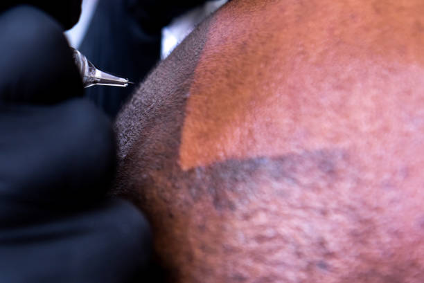 istock Scalp Micro-pigmentation of bald African-American man 1198745718