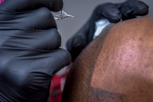 Close up shot of scalp micro-pigmentation for bald men. Medical treatment for hair imitation. Afro American.