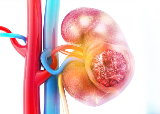 riñón humano enfermo sobre antecedentes científicos - kidney cancer fotografías e imágenes de stock