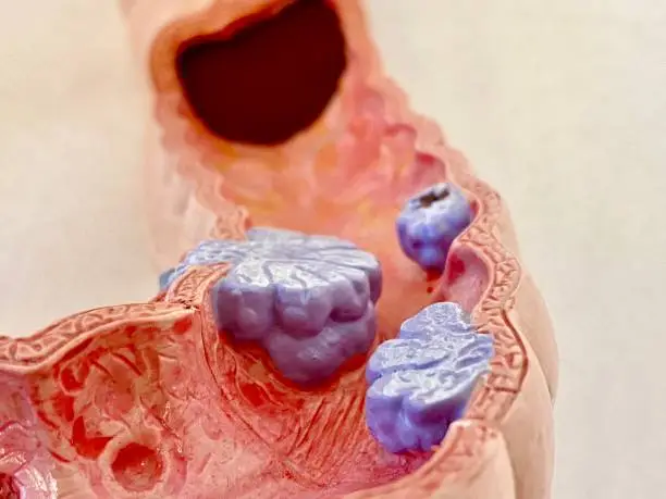 Anatomical model of colon cancer