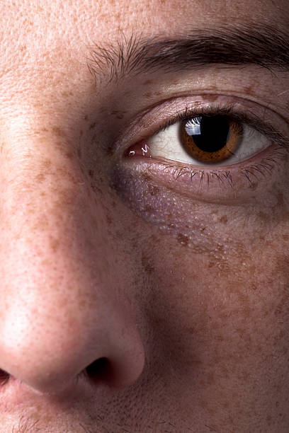 istock Eye and Freckles 119889075