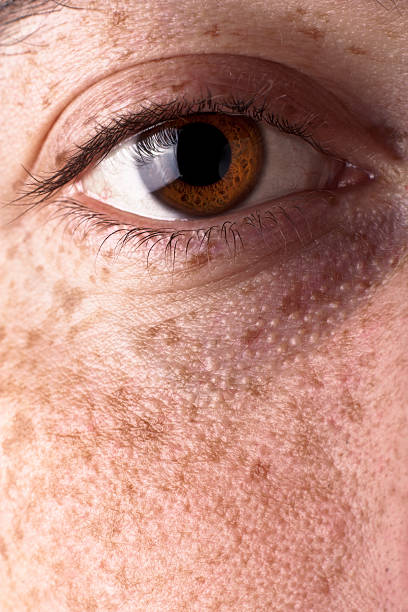 istock Eye and Freckles 119889101