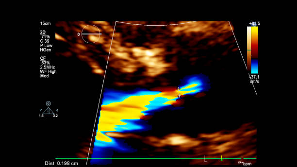 изображение сердца во время трансезофагеального ультразвука. - pulmonary valve стоковые фото и изображения