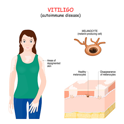 Vitiligo Autoimmune Disease Stock Illustration - Download Image Now -  Vitiligo, Biological Cell, Dermis - iStock