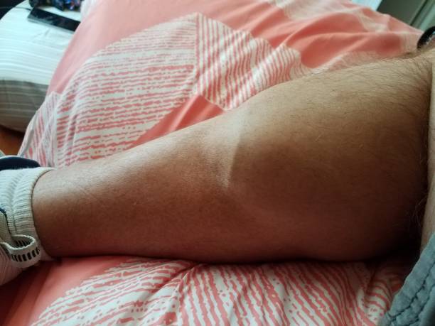 Male Calf Muscle And Leg With Vein And Hair On Peach Blanket Stock Photo - Download Image Now - iStock Male Calf Muscle And Leg With Vein And Hair On Peach Blanket Stock Photo - Download Image Now - iStock