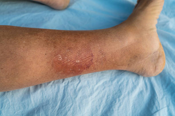 Erysipelas Bacterial infection, gout leg Erysipelas bacterial infection Under the skin leg, on blue bedding. ringworm photos stock pictures, royalty-free photos & images