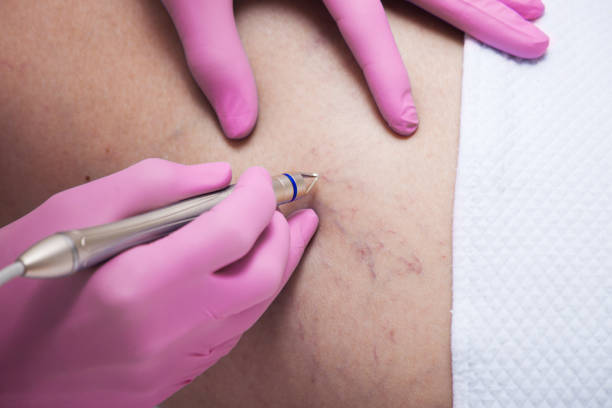 istock closeup of laser capillary removal procedure 1199310078