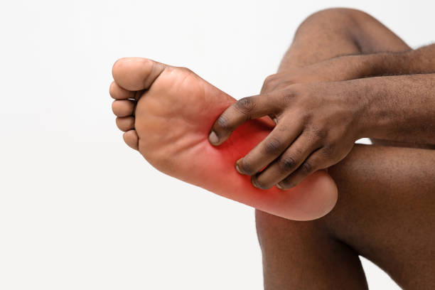 Black man scratching bare foot with red rush Afro man scratching bare foot, Athlete's foot syndrom, common skin infection caused by fungus, cropped ringworm photos stock pictures, royalty-free photos & images