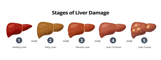 Stages of liver damage from healthy, fatty liver, fibrosis, cirrhosis to liver cancer. Medical infographic, liver diseases icons in flat design isolated on white background. Stages of liver damage from healthy, fatty liver, fibrosis, cirrhosis to liver cancer. Medical infographic, liver diseases icons in flat design isolated on white background cirrhosis stock illustrations