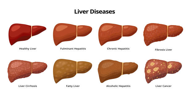 Healthy Liver and Liver diseases - fatty liver, hepatitis, fibrosis, cirrhosis, alcoholic hepatitis, liver cancer - medical infographic elements isolated on white background. Healthy Liver and Liver diseases - fatty liver, hepatitis, fibrosis, cirrhosis, alcoholic hepatitis, liver cancer - medical infographic elements isolated on white background cancer illness illustrations stock illustrations