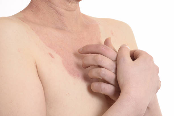 istock Skin disease on female breast 1199515667