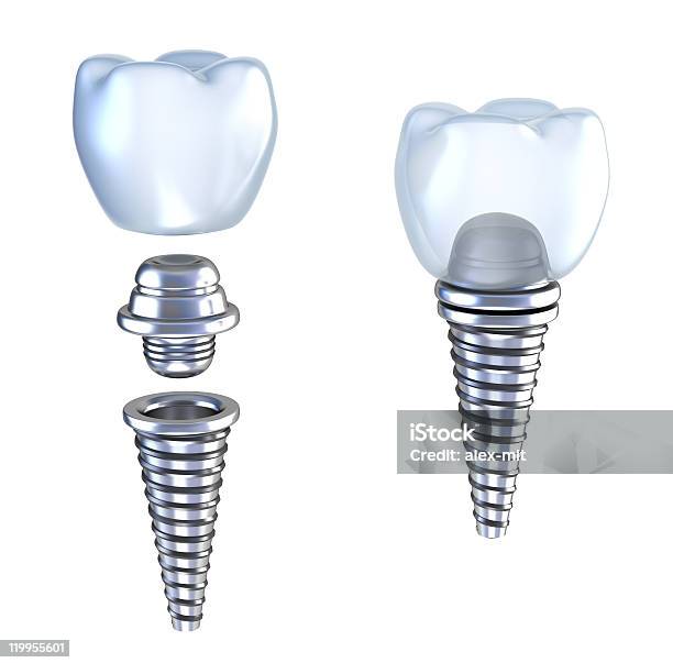 Зубной Имплантат 3d Crown С Pin — стоковые фотографии и другие картинки Здоровье зубов - Здоровье зубов, Штифт, Белый