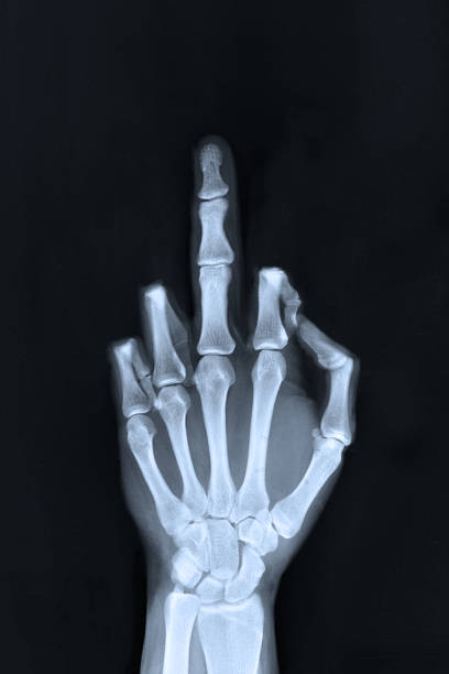 Flipped finger xray Hand sign x-ray of a flipped finger / middle finger sign. roentgen stock pictures, royalty-free photos & images