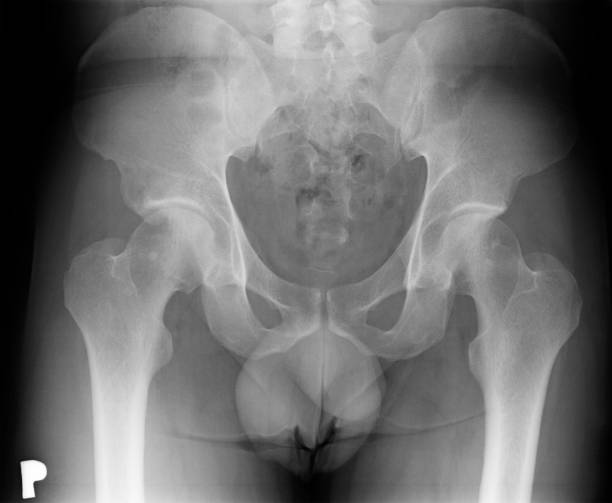 profilaktyczne i kontrolne badanie lekarskie. początkowy etap zwyrodnieniowy prawego stawu biodrowego. x-ray kości biodrowych i biodrowych. - hip femur ilium pelvis zdjęcia i obrazy z banku zdjęć